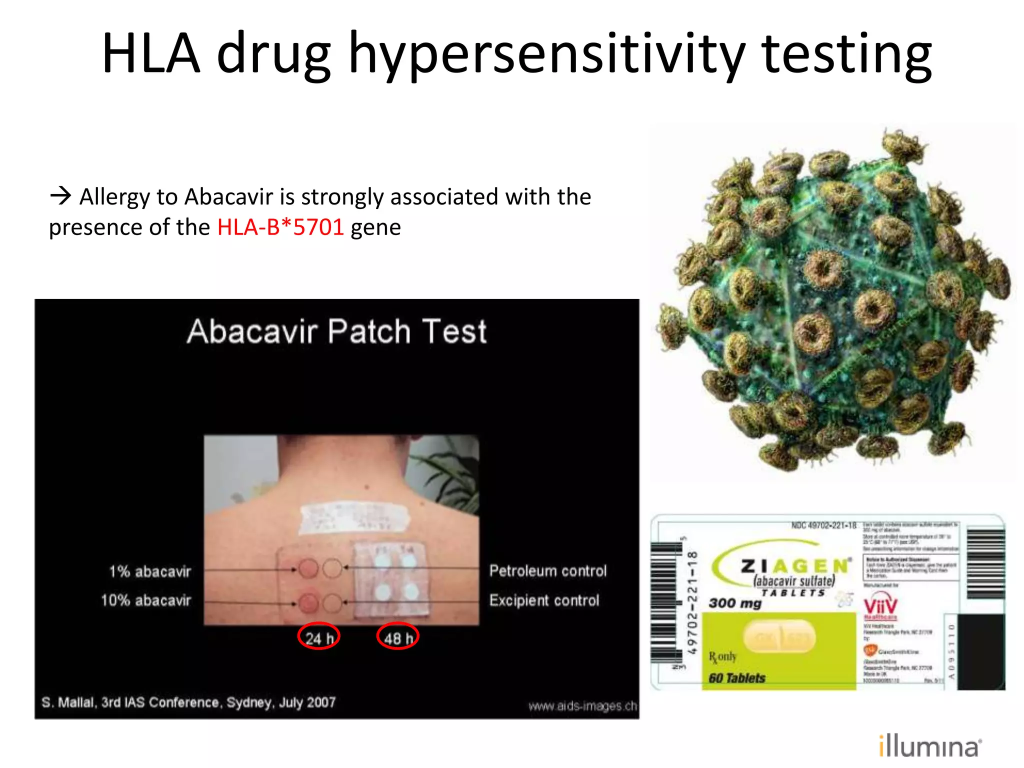 HLA drug hypersensitivity testing
 Allergy to Abacavir is strongly associated with the
presence of the HLA-B*5701 gene
 
