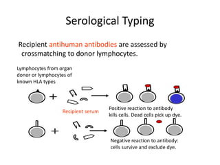 Serological Typing
Recipient antihuman antibodies are assessed by
crossmatching to donor lymphocytes.
Recipient serum
Lymphocytes from organ
donor or lymphocytes of
known HLA types
Positive reaction to antibody
kills cells. Dead cells pick up dye.
Negative reaction to antibody:
cells survive and exclude dye.
 