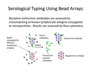 Serological Typing Using Bead Arrays
Recipient antihuman antibodies are assessed by
crossmatching to known lymphocyte antigens conjugated
to microparticles. Results are assessed by flow cytometry.
Positive for antibody
Serum
antibodies
(Wash)
Negative for antibody
Beads
conjugated to
different
lymphocyte
antigens
Fluorescent
reporter
antibodies
 