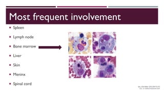 Most frequent involvement
 Spleen
 Lymph node
 Bone marrow
 Liver
 Skin
 Meninx
 Spinal cord
 