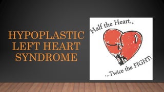 HYPOPLASTIC
LEFT HEART
SYNDROME
 