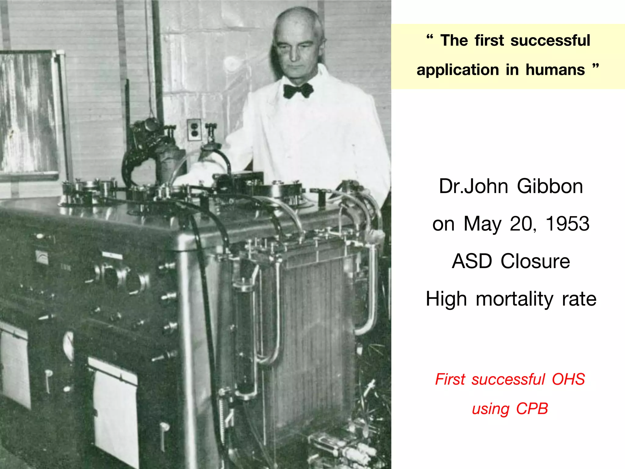 Dr.John Gibbon
on May 20, 1953
ASD Closure
High mortality rate
“ The first successful
application in humans ”
First successful OHS
using CPB
 
