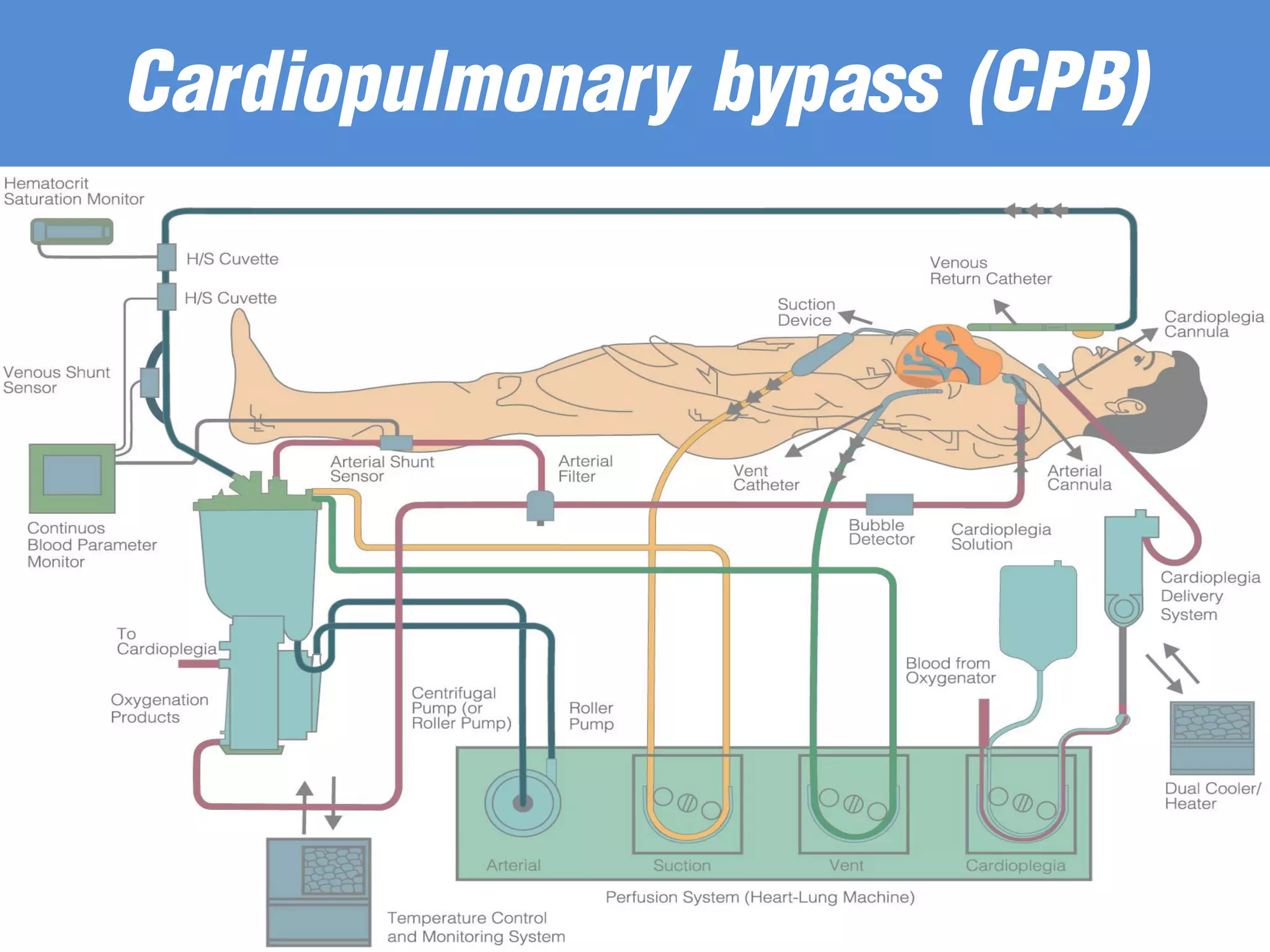 Cardiopulmonary bypass (CPB)
 