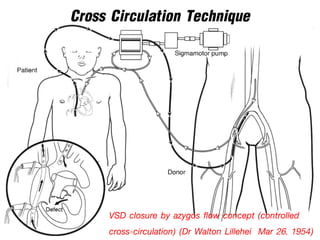 Cross Circulation Technique
VSD closure by azygos flow concept (controlled
cross-circulation) (Dr Walton Lillehei Mar 26, 1954)
 