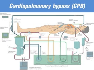 Cardiopulmonary bypass (CPB)
 