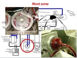 Blood pump
 