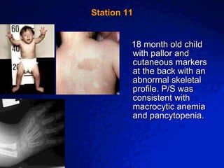 © 2003 By Default!
A Free sample background from www.awesomebackgrounds.com
Slide 23
Station 11
18 month old child
with pallor and
cutaneous markers
at the back with an
abnormal skeletal
profile. P/S was
consistent with
macrocytic anemia
and pancytopenia.
 