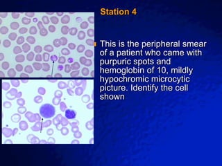 © 2003 By Default!
A Free sample background from www.awesomebackgrounds.com
Slide 8
Station 4
 This is the peripheral smear
of a patient who came with
purpuric spots and
hemoglobin of 10, mildly
hypochromic microcytic
picture. Identify the cell
shown
 