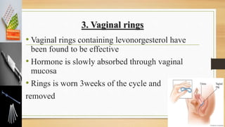 3. Vaginal rings
• Vaginal rings containing levonorgesterol have
been found to be effective
• Hormone is slowly absorbed through vaginal
mucosa
• Rings is worn 3weeks of the cycle and
removed
 