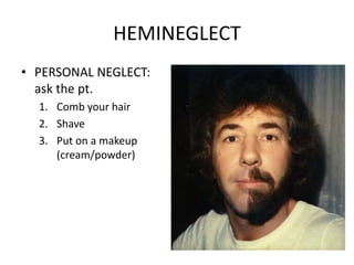 HEMINEGLECT
• PERSONAL NEGLECT:
ask the pt.
1. Comb your hair
2. Shave
3. Put on a makeup
(cream/powder)
 