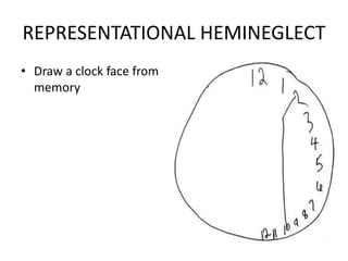 REPRESENTATIONAL HEMINEGLECT
• Draw a clock face from
memory
 