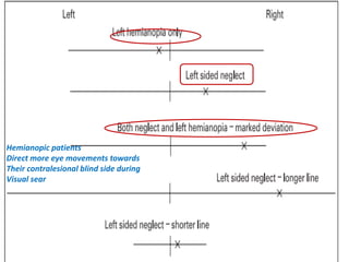 Hemianopic patients
Direct more eye movements towards
Their contralesional blind side during
Visual sear
 