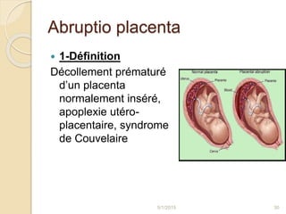 Abruptio placenta
 1-Définition
Décollement prématuré
d’un placenta
normalement inséré,
apoplexie utéro-
placentaire, syndrome
de Couvelaire
5/1/2015 30
 