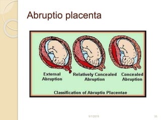 Abruptio placenta
5/1/2015 33
 