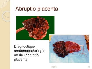 Abruptio placenta
5/1/2015 39
Diagnostique
anatomopathologiq
ue de l’abruptio
placenta
 