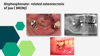 HOST MODULATION THERAPY | PPTX