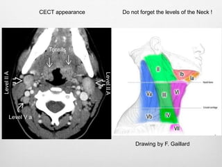 Head and Neck Masses In Children | PPTX