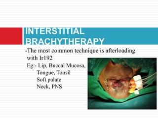 The most common technique is afterloading
with Ir192
Eg:- Lip, Buccal Mucosa,
Tongue, Tonsil
Soft palate
Neck, PNS
INTERSTITIAL
BRACHYTHERAPY
 