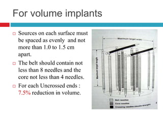 For volume implants
 Sources on each surface must
be spaced as evenly and not
more than 1.0 to 1.5 cm
apart.
 The belt should contain not
less than 8 needles and the
core not less than 4 needles.
 For each Uncrossed ends :
7.5% reduction in volume.
 