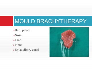 Hard palate
Nose
Face
Pinna
Ext.auditory canal
MOULD BRACHYTHERAPY
 