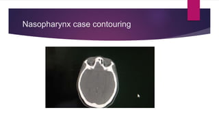 Nasopharynx case contouring
 