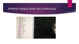 Anterior tongue (post op) contouring
 