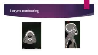 Larynx contouring
 