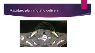 Rapidarc planning and delivery
 
