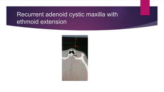 Recurrent adenoid cystic maxilla with
ethmoid extension
 