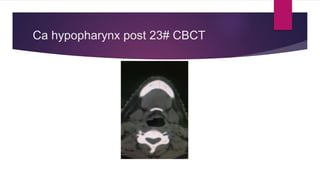 Ca hypopharynx post 23# CBCT
 