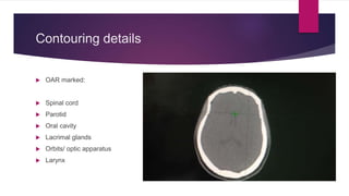 Contouring details
 OAR marked:
 Spinal cord
 Parotid
 Oral cavity
 Lacrimal glands
 Orbits/ optic apparatus
 Larynx
 