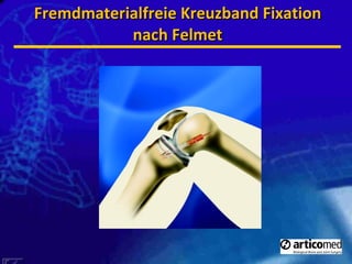 Fremdmaterialfreie Kreuzband Fixation nach Felmet 