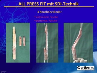 anteromed. Fascikel posterolat. Fascikel 4 Knochenzylinder: ALL PRESS FIT mit SDI-Technik 