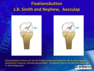 Fixationsbutton z.B. Smith and Nephew,  Aesculap   Schwierigkeiten können sich bei der Fixation sowie beim Spannen des Knopfes ergeben. Gelenkferne Fixierung, Scheibenwischereffekt , EndoButton flipt an der falschen Stelle z.B. im Weichteilgewebe  