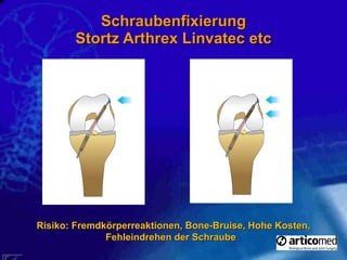 Schraubenfixierung Stortz Arthrex Linvatec etc Risiko: Fremdkörperreaktionen, Bone-Bruise, Hohe Kosten, Fehleindrehen der Schraube  