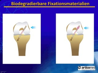 Biodegradierbare Fixationsmaterialien 