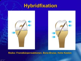 Hybridfixation Risiko: Fremdkörperreaktionen, Bone-Bruise, Hohe Kosten  