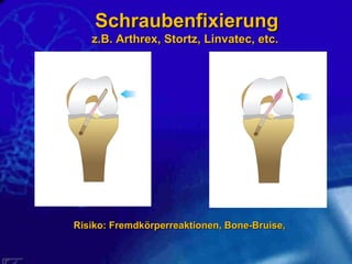 Risiko: Fremdkörperreaktionen, Bone-Bruise,  Schraubenfixierung z.B. Arthrex, Stortz, Linvatec, etc.  