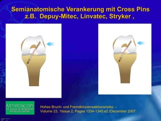 Semianatomische Verankerung mit Cross Pins z.B.  Depuy-Mitec, Linvatec, Stryker ,  Hohes Bruch- und Fremdkörperreaktionsrisiko  -  Volume 23, 1Issue 2, Pages 1334-1340.e2 (December 2007 