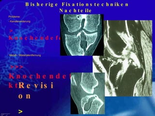 Bisherige Fixationstechniken Nachteile  Probleme: Kanalerweiterung > Knochendefekte Metall- / Materialentfernung >>> Knochendefekte Revision > Kosten 