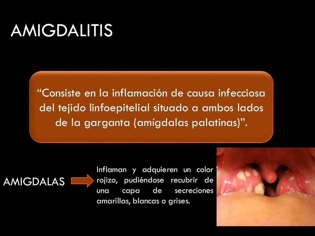 Amigdalitis