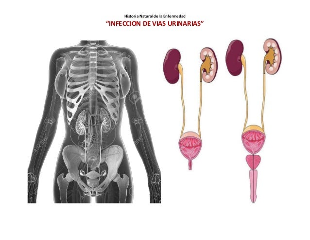 Historia Natural: Infección de Vías Urinarias