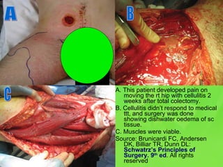 A. This patient developed pain on moving the rt hip with cellulitis 2 weeks after total colectomy. B. Cellulitis didn’t respond to medical ttt, and surgery was done showing dishwater oedema of sc tissue. C. Muscles were viable. Source: Brunicardi FC, Andersen DK, Billiar TR, Dunn DL:  Schwatrz’s Principles of Surgery. 9 th  ed . All rights reserved A B C 