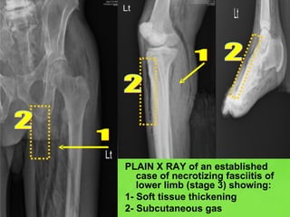 PLAIN X RAY of an established case of necrotizing fasciitis of lower limb (stage 3) showing: 1- Soft tissue thickening 2- Subcutaneous gas 1 1 2 2 2 