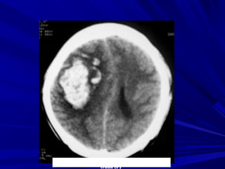 Nguyeãn Hoaøng H., Nam, 22 tuoåi, Xuaát huyeát
traùn (P)
 