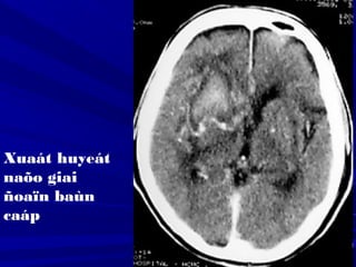 Xuaát huyeát
naõo giai
ñoaïn baùn
caáp
 