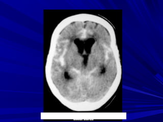Ñoaøn thò S., Nöõ, 80 tuoåi, Xuaát huyeát khoang
döôùi nheän
 