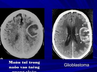 Glioblastoma
Maùu tuï trong
naõo vaø taêng
 