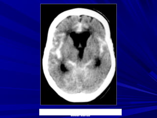 Ñoaøn thò S., Nöõ, 80 tuoåi, Xuaát huyeát khoang
döôùi nheän
 