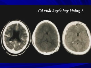 Có xuất huyết hay không ?
 